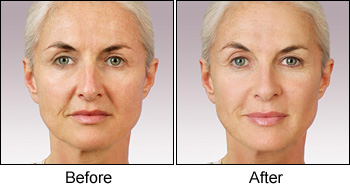 Before and After Photos