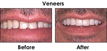 Veneers