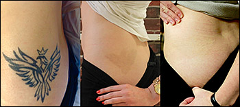 Tataway Tattoo Removal Clinic